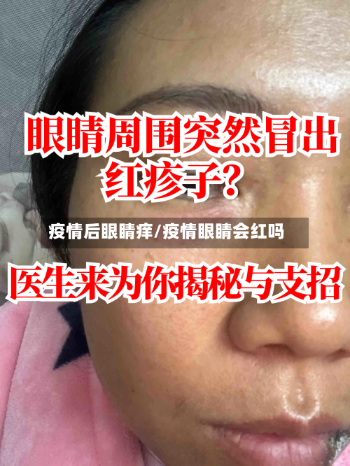 疫情后眼睛痒/疫情眼睛会红吗-第2张图片