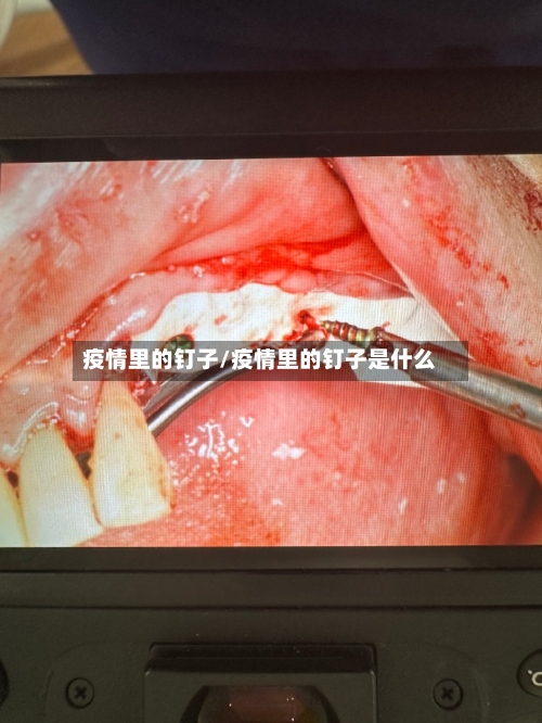 疫情里的钉子/疫情里的钉子是什么-第3张图片